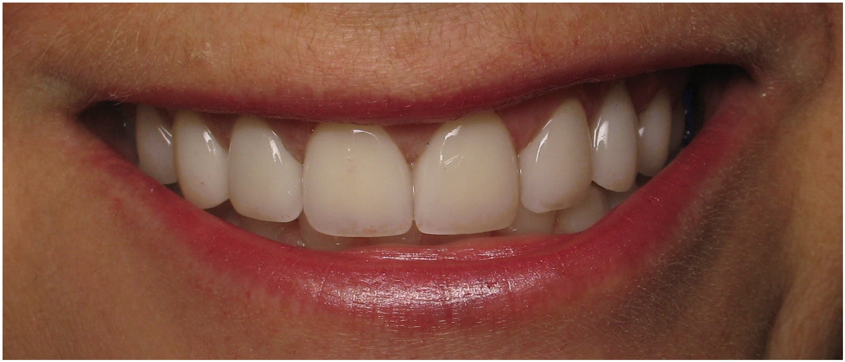 Look Younger Today Cosmetic Dentistry Bergen County Kurpis Center